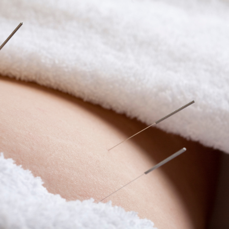 Acupuncture Journal Club: Effects of Acupuncture during Labor and Delivery – Citkovitz et al, 2009